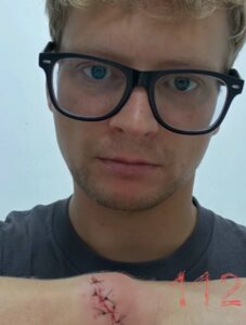 Мурена укусила россиянина в Таиланде. Часть зуба хищницы осталась в руке мужчины.