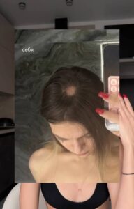 Москвичка лишилась волос после примерки шапки с маркетплейса.